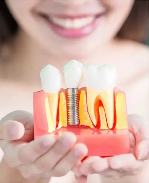 Kobieta trzymająca model anatomiczny szczęki przedstawiający implant stomatologiczny osadzony w kości.