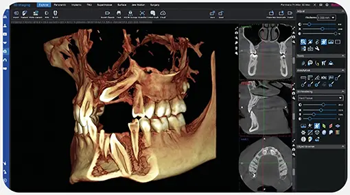 Trójwymiarowy model tomografii komputerowej szczęki (CBCT) wyświetlony w specjalistycznym oprogramowaniu diagnostycznym.