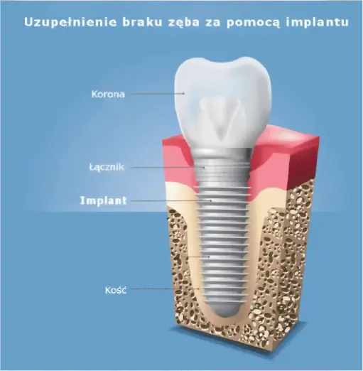 Schemat budowy implantu zębowego z opisami: korona, łącznik, implant i kość.